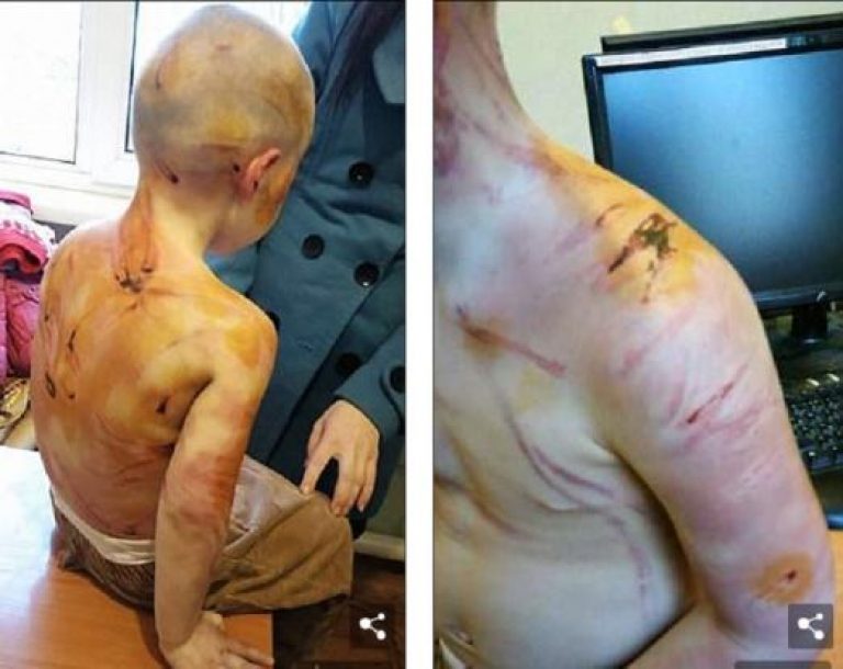 “Άνδρας”, σάπισε στο ξύλο την 4χρονη κόρη της ερωμένης του, επειδή δεν ήθελε να μετρήσει μέχρι το πέντε