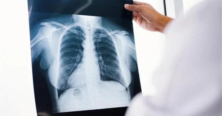 Καρκίνος Πνεύμονα: Όταν η Επιστήμη Συναντά την Ελπίδα